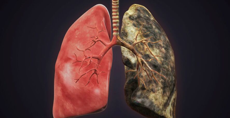 Smoker lung and stop smoking lung