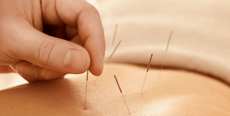 Acupuncture for smoking